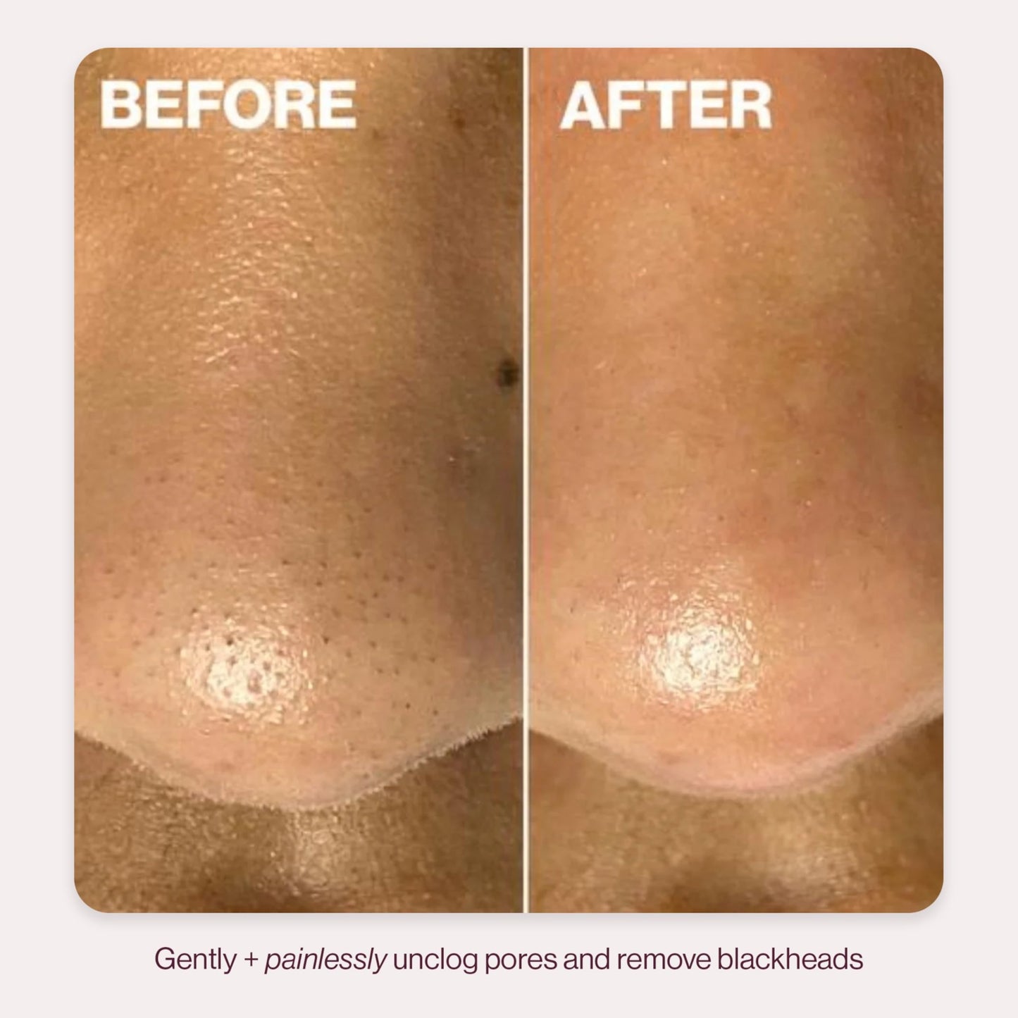DERMAFLASH DERMAPORE+ Skin Care Device, Ultrasonic 2-in-1 Pore Extractor and Skincare Infuser, Blush