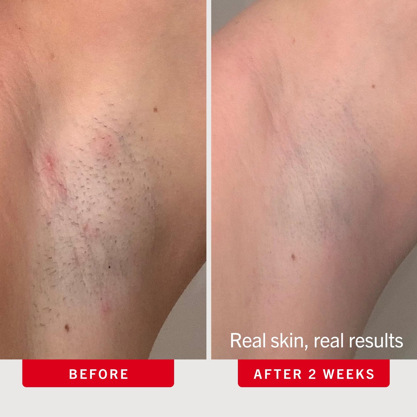 First Aid Beauty Ingrown Hair Pads, Body & Face with BHA & AHA - Dermatologist-Tested Aftershave Treatment to Help Prevent Razor Bumps & Exfoliate Underarms & Bikini Area - Sensitive Skin - 28 Count