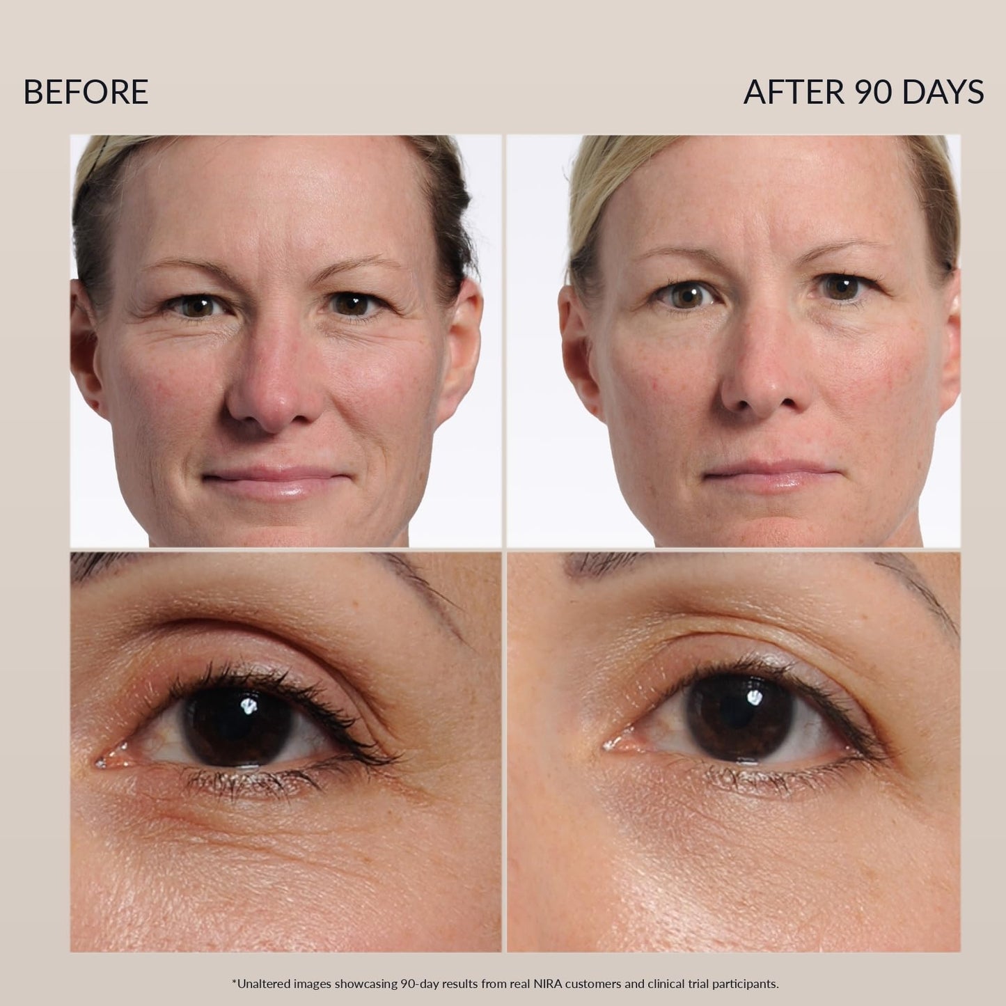 NIRA Pro 3 Laser - FDA-Cleared-At-Home Anti Aging Device for Wrinkle Reduction & Collagen Stimulation, Full Face & Neck Treatment, Pain-Free, Clinically Proven