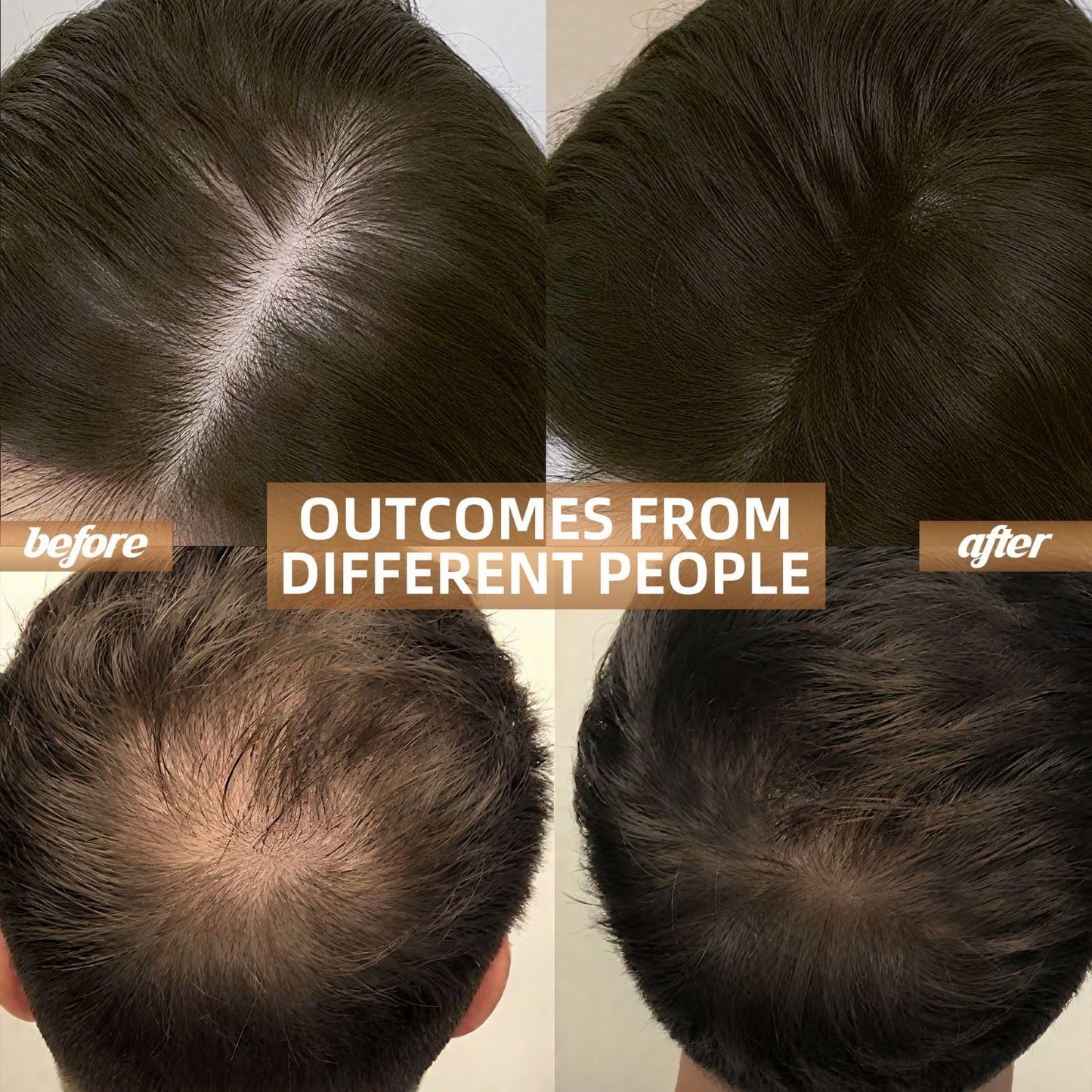Red Light Therapy for Hair, Hair Loss Treatments Hat