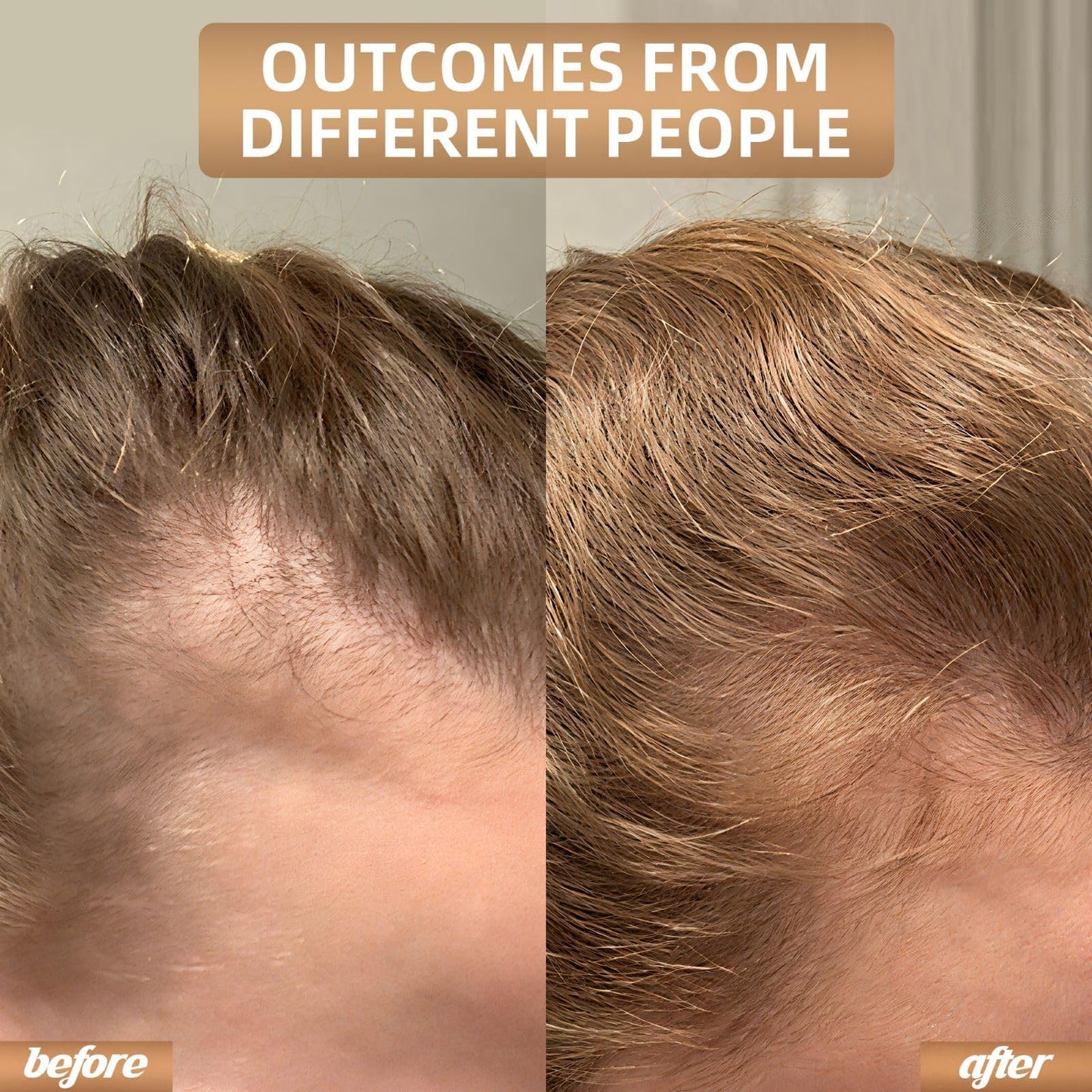 Red Light Therapy for Hair, Hair Loss Treatments Hat