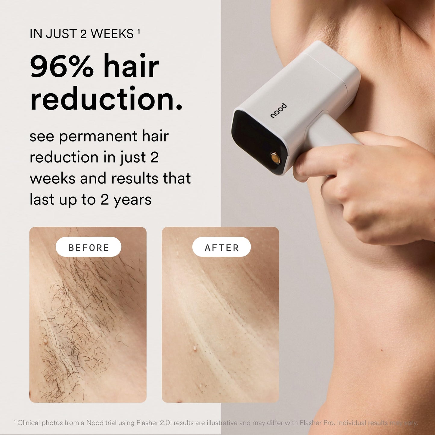Nood™ Flasher Pro — Forbes Best Product 2026 — IPL Laser Hair Removal Device For At Home Use — Pain-Free, Permanent, Visible Results After First Use & Works Everywhere Hair Grows — Gloss White