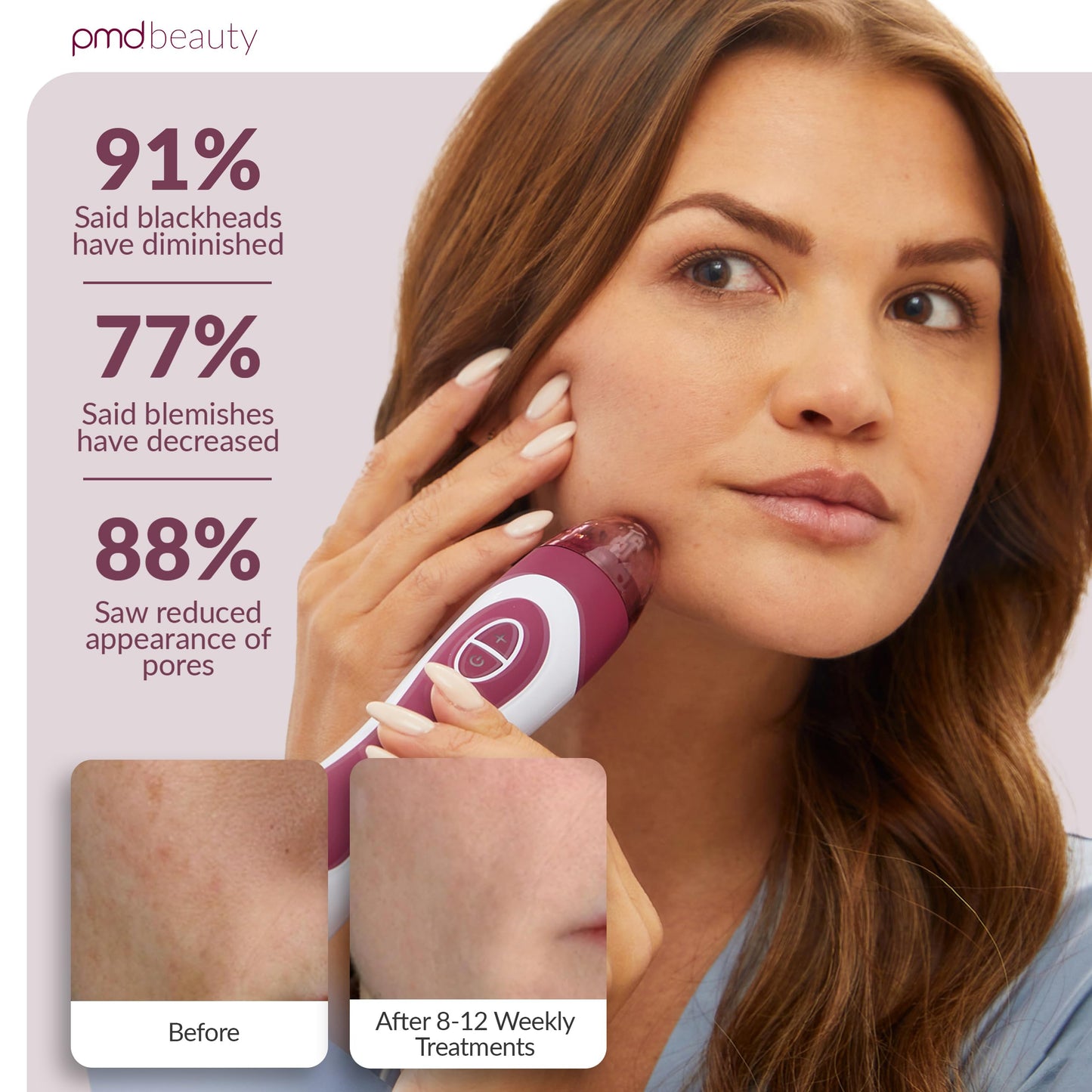 PMD Personal Microderm Elite Pro - At-Home Microdermabrasion Machine with Kit for Face and Body - Exfoliating Crystals and Vacuum Suction for Fresh and Radiant Skin - Three Speed and Suction Options